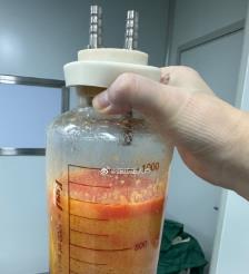 改则水动力吸脂手术要做多久？